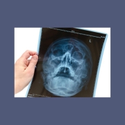 Materiais radiológicos úteis para a identificação: raio x de seios da face (sinusite)